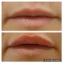 Fillers