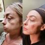 Full Face treatment -  I takt med att vi åldras förlorar ansiktets sin naturliga volym. Med filler kan vi återskapa det. Under en konsultation skräddarsyr vi en behandling efter dina önskemål.