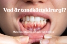Vad är tandköttskirurgi Metoder. läkning och när det behövs