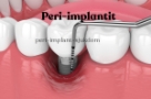 Periimplantit- Periimplantitis