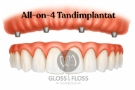 All-on-4 Tandimplantat