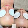 Hydrafacial