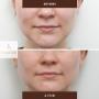 Hydrafacial