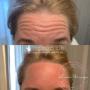 Botox Panna - Örebro Estetik